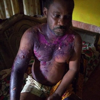 Angry Wife Pours Hot Water On Husband While He Was Asleep In Yenagoa (Photo)