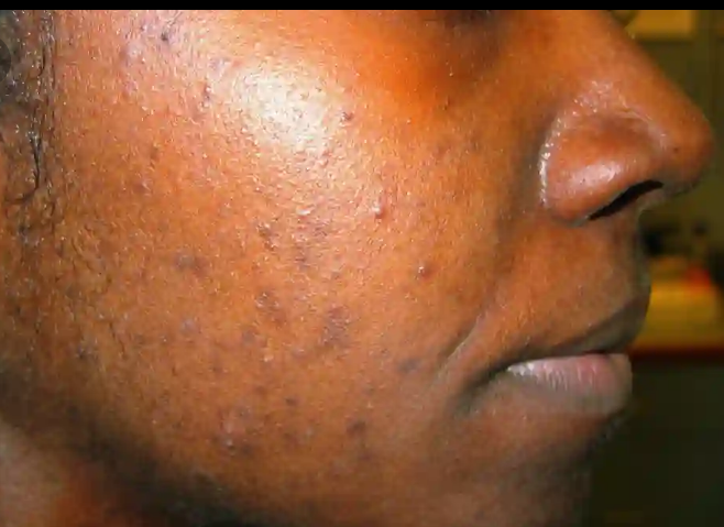 How to Get Rid of Your Acne and Scars(Home Remedy)